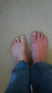 bout with gout